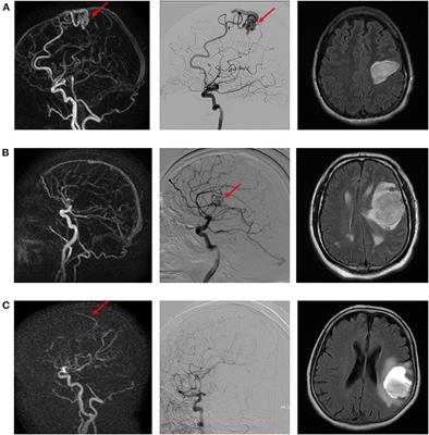 Diagnostic performance of dynamic 3D magnetic resonance angiography in daily practice for the detection of intracranial arteriovenous shunts in patients with non-traumatic intracranial hemorrhage